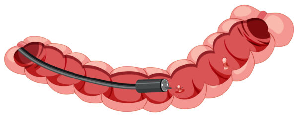 Ilustração de colonoscópio dentro do intestino grosso