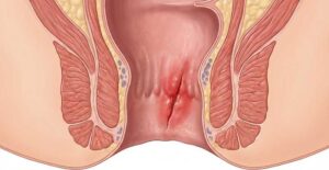 Ilustração anatômica de fissura anal