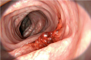 Tudo Sobre Câncer Colorretal Imagem de colonoscopia mostrando pólipo no intestino grosso