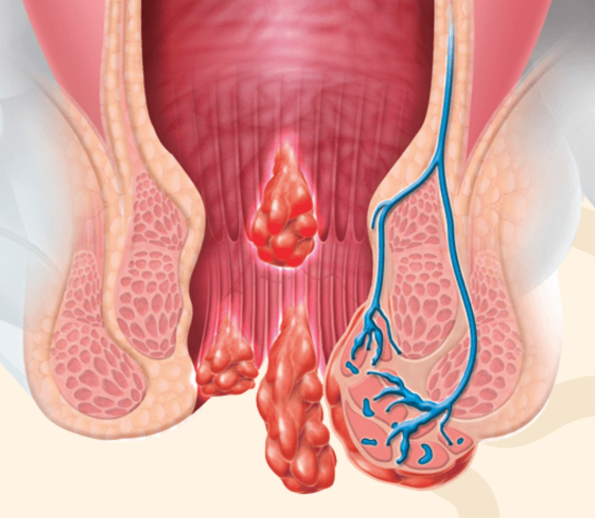 Ilustração anatômica de hemorroidas internas e externas