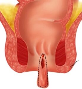 Tudo Sobre Câncer Colorretal Ilustração anatômica de plicoma anal